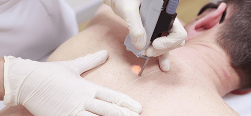Hair Removal with Laser Machines